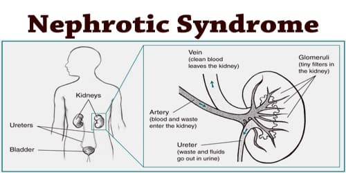 Nephrotic-Syndrome 